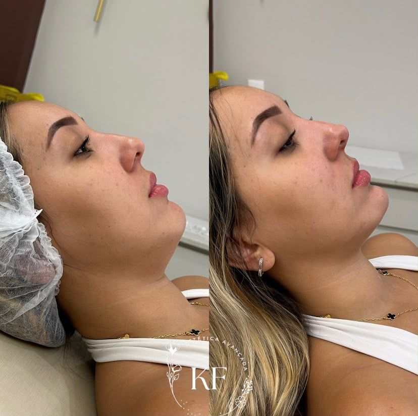 Antes e depois de perfiloplastia com preenchimento de mento e mandíbula