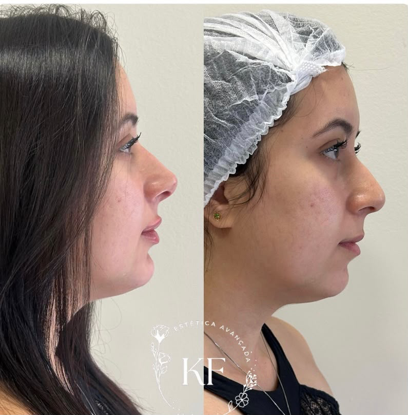 Antes e depois de perfiloplastia com harmonização do contorno facial