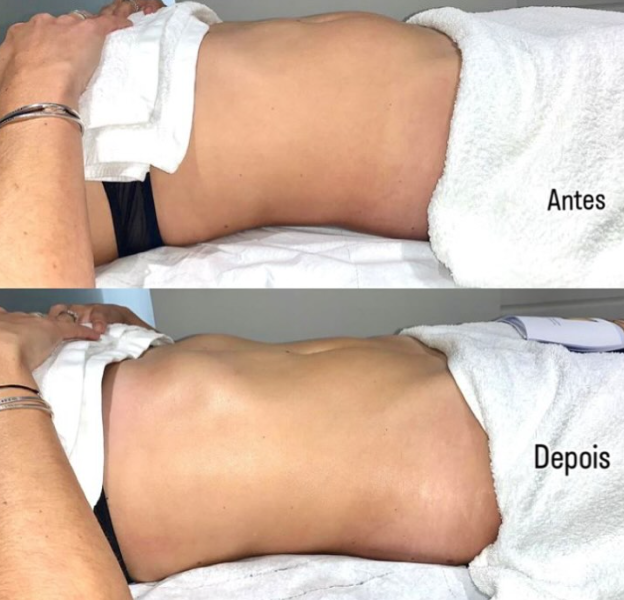 Antes e depois de tratamento de contorno corporal com fisioterapia dermatofuncional